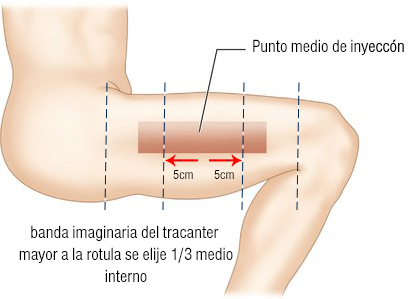 im-vasto externo